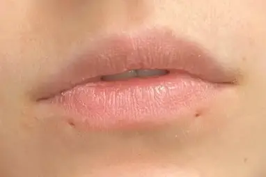 Redness or swelling that extends beyond the piercing site may be a sign of infection. Do Lip Piercings Leave Permanent Scars New York Gal